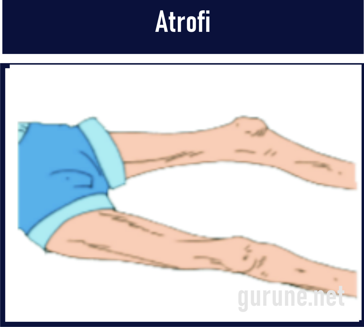 Detail Gambar Penyakit Atropi Nomer 4