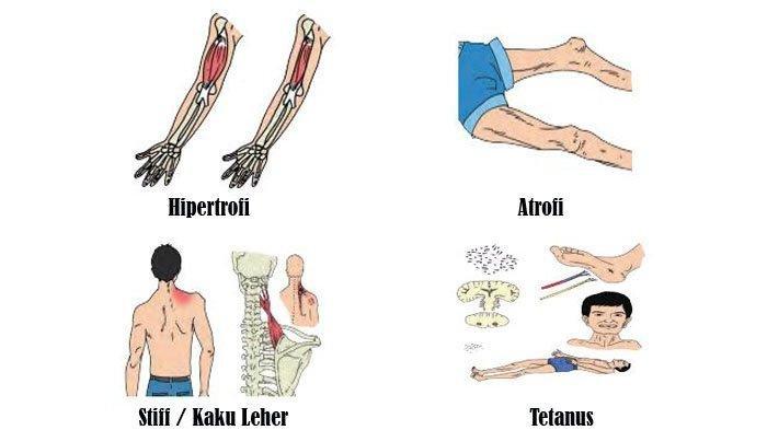 Detail Gambar Penyakit Atropi Nomer 5