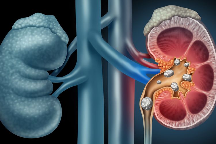 Gambar Penyakit Batu Ginjal - KibrisPDR