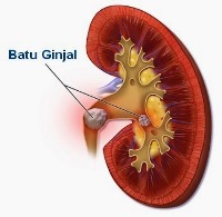 Detail Gambar Penyakit Batu Ginjal Nomer 13