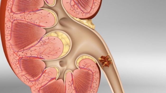 Detail Gambar Penyakit Batu Ginjal Nomer 16