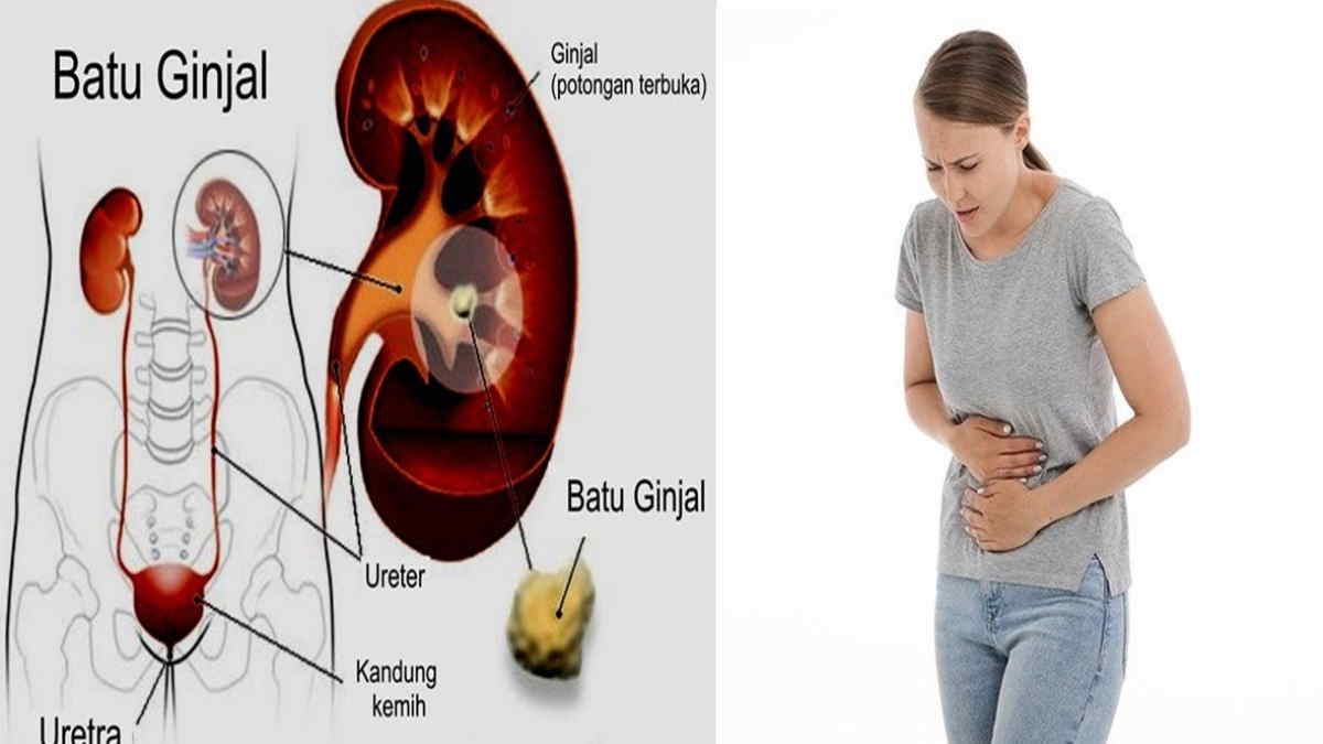 Detail Gambar Penyakit Batu Ginjal Nomer 3