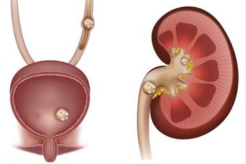 Detail Gambar Penyakit Batu Ginjal Nomer 32