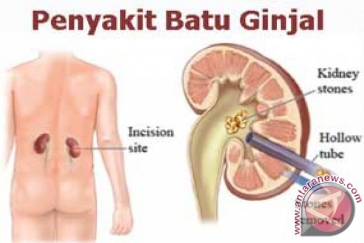 Detail Gambar Penyakit Batu Ginjal Nomer 37