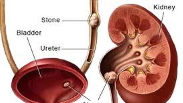 Detail Gambar Penyakit Batu Ginjal Nomer 42