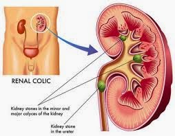 Detail Gambar Penyakit Batu Ginjal Nomer 43