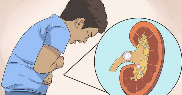 Detail Gambar Penyakit Batu Ginjal Nomer 50