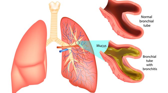 Gambar Penyakit Bronkitis - KibrisPDR