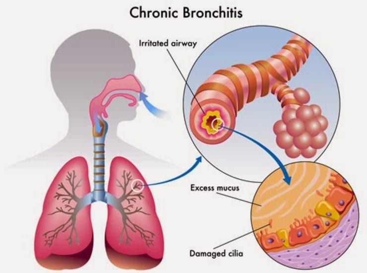 Detail Gambar Penyakit Bronkitis Nomer 14