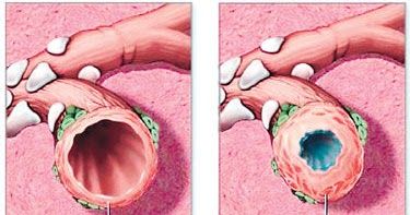Detail Gambar Penyakit Bronkitis Nomer 37