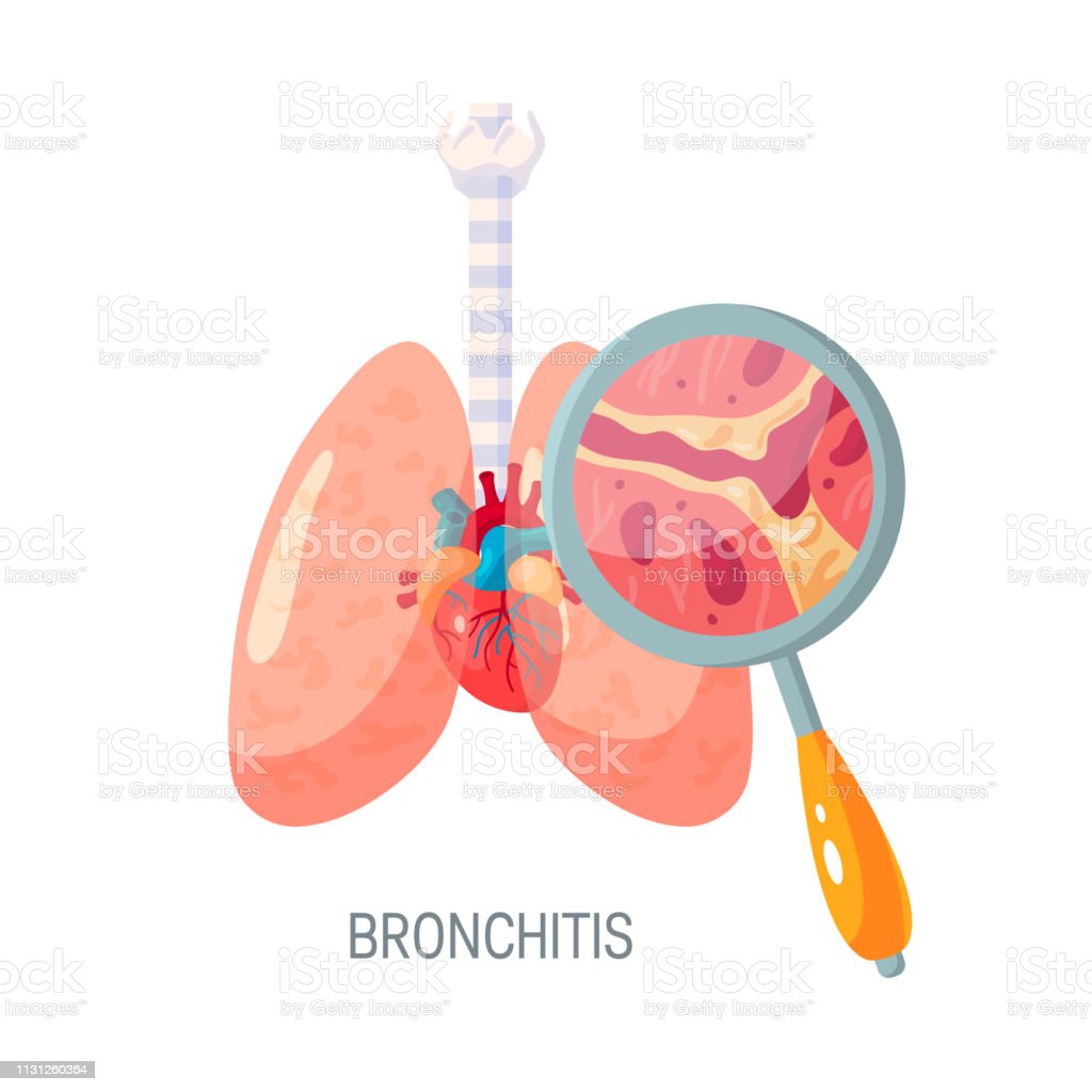 Detail Gambar Penyakit Bronkitis Nomer 39