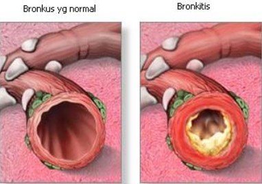 Detail Gambar Penyakit Bronkitis Nomer 49