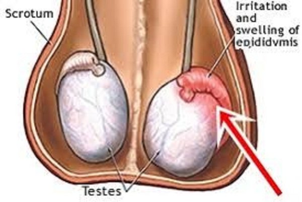 Detail Gambar Penyakit Buah Zakar Nomer 10