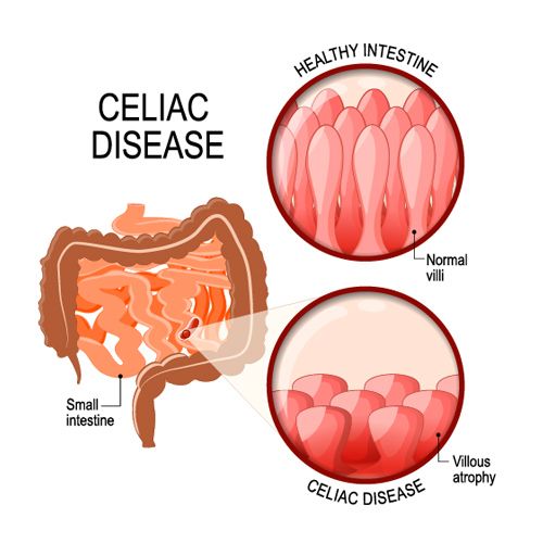 Detail Gambar Penyakit Celiac Nomer 2