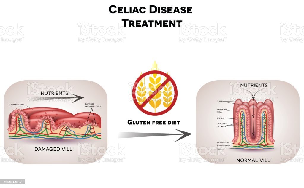 Detail Gambar Penyakit Celiac Nomer 15