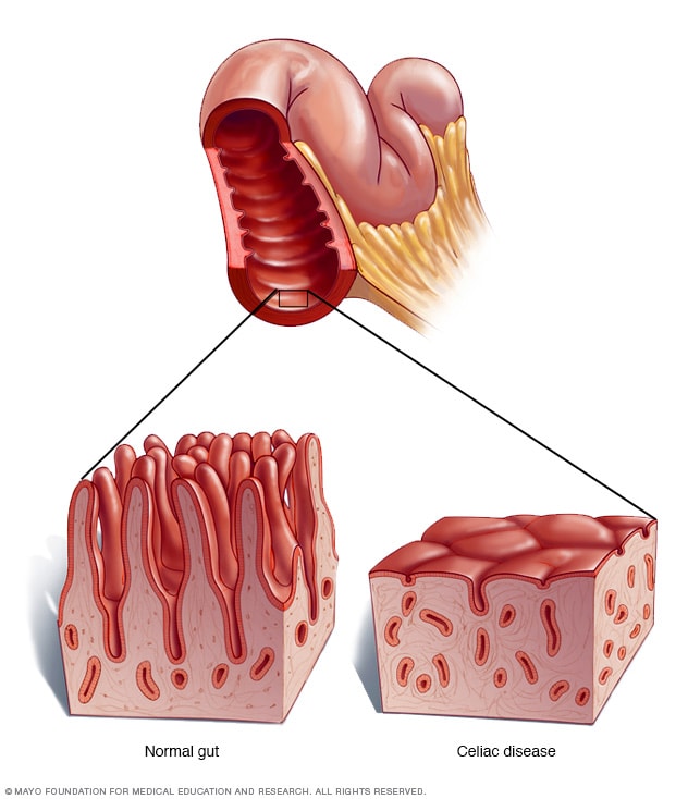 Detail Gambar Penyakit Celiac Nomer 18