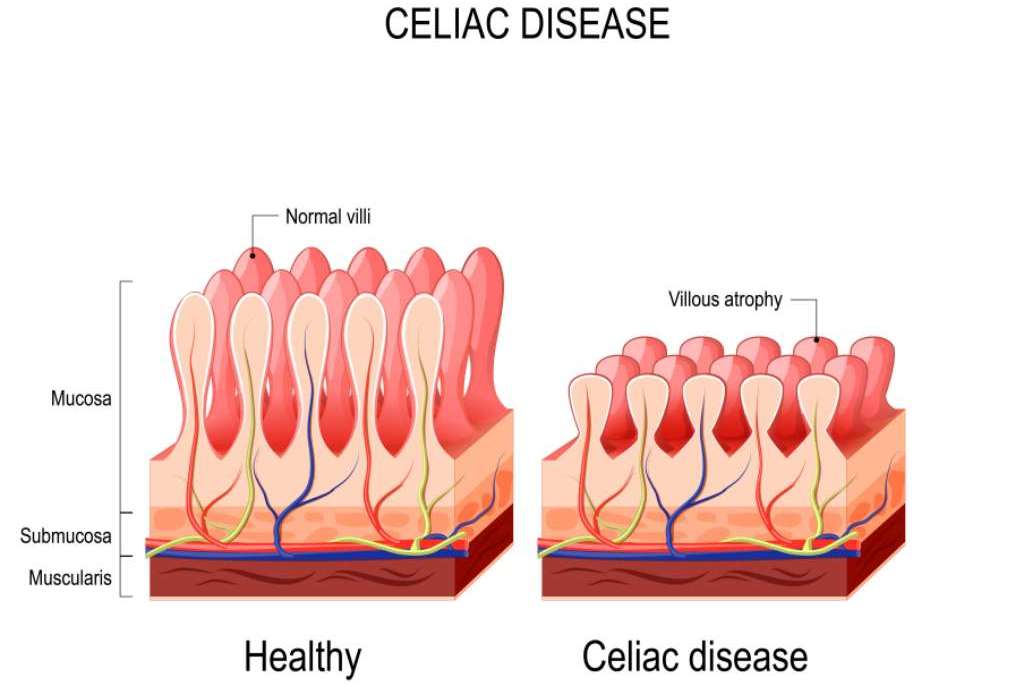 Detail Gambar Penyakit Celiac Nomer 4