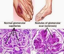 Detail Gambar Penyakit Diabetes Glukosuria Nomer 3