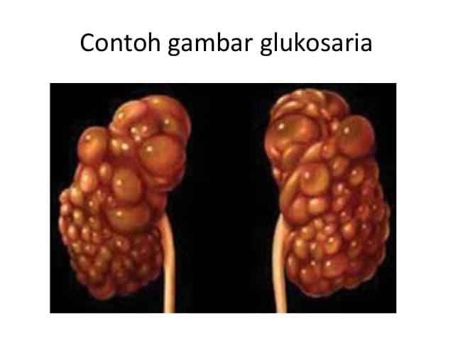 Detail Gambar Penyakit Diabetes Glukosuria Nomer 4