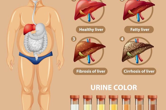 Detail Gambar Penyakit Diabetes Insipidus Nomer 12