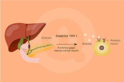 Detail Gambar Penyakit Diabetes Insipidus Nomer 22