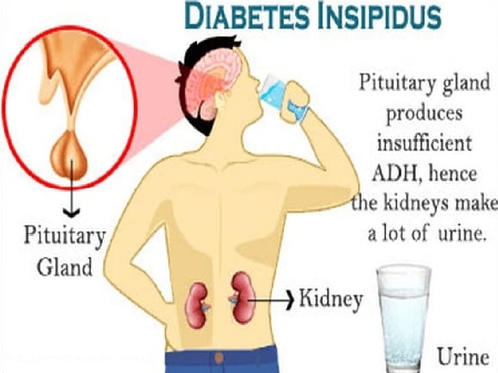 Detail Gambar Penyakit Diabetes Insipidus Nomer 7