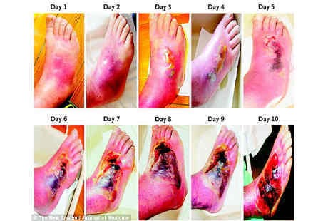 Detail Gambar Penyakit Diabetes Melitus Nomer 12