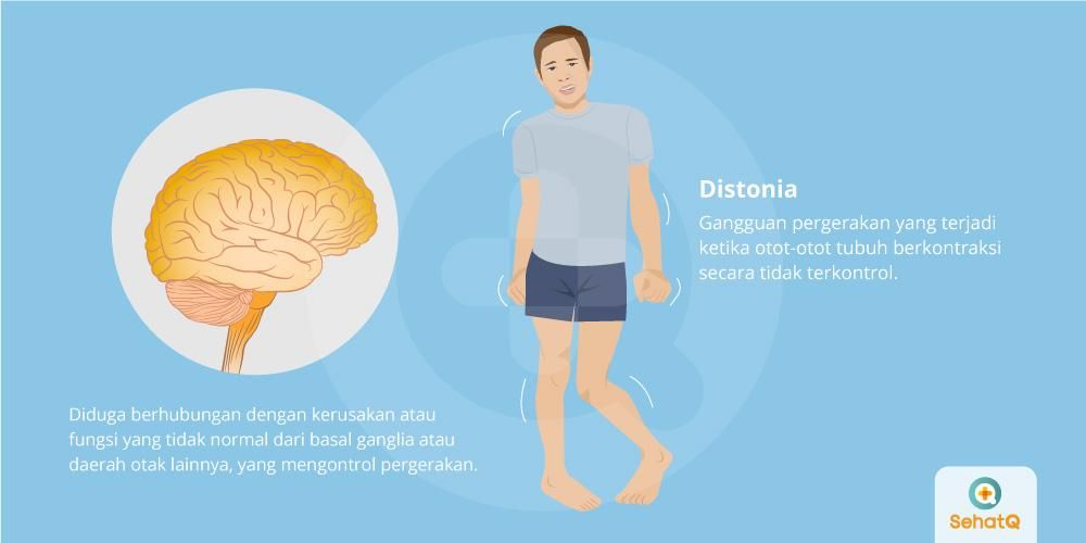 Gambar Penyakit Dystonia - KibrisPDR