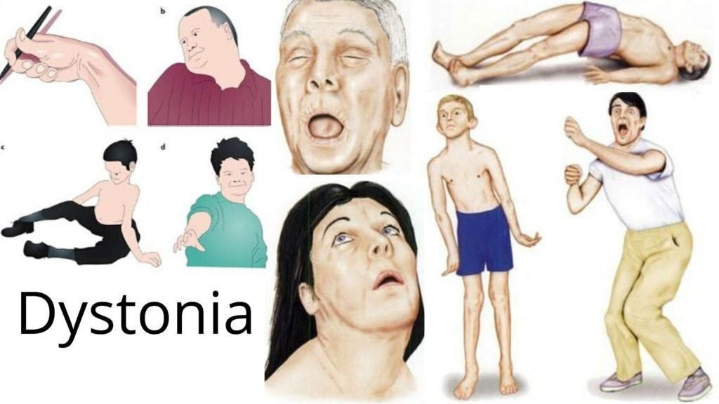 Detail Gambar Penyakit Dystonia Nomer 2