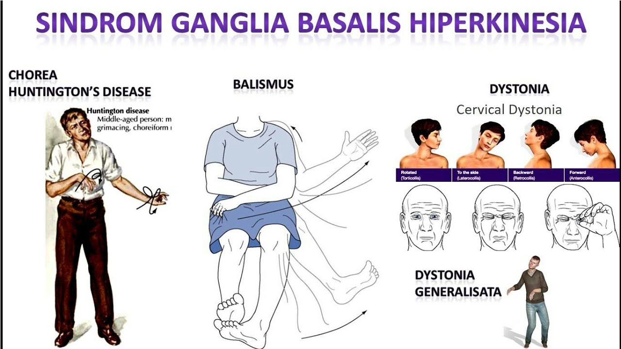 Detail Gambar Penyakit Dystonia Nomer 36