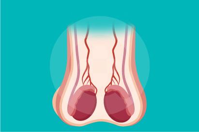 Detail Gambar Penyakit Epididimitis Nomer 9