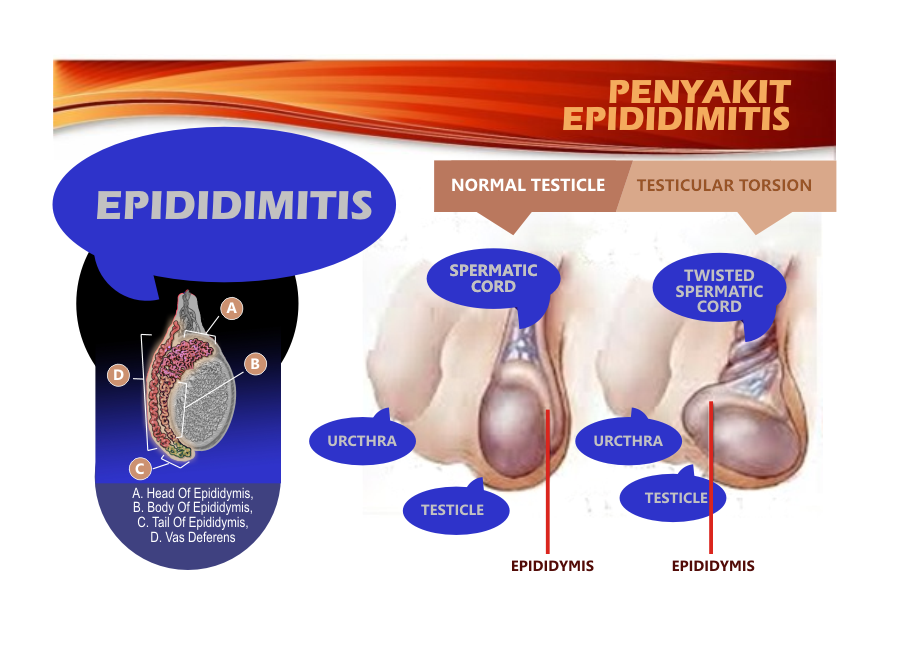 Detail Gambar Penyakit Epididimitis Nomer 15