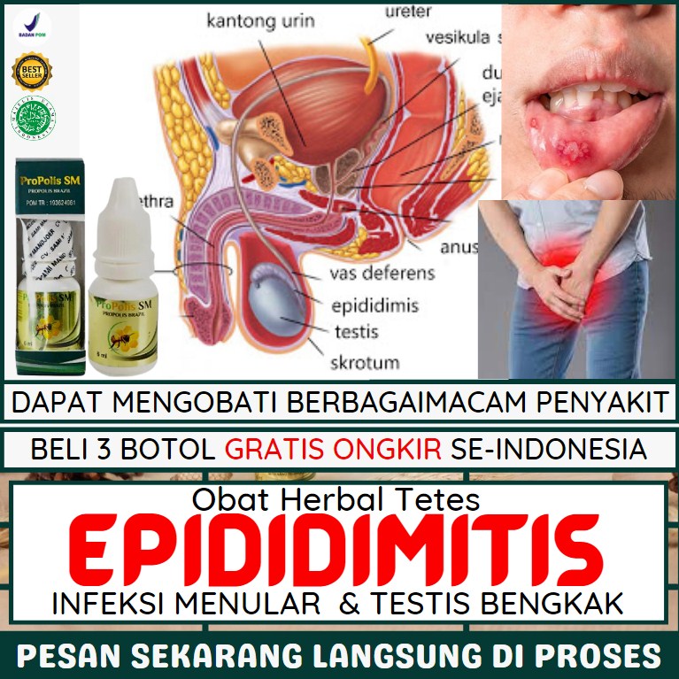 Detail Gambar Penyakit Epididimitis Nomer 22