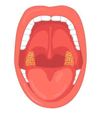 Detail Gambar Penyakit Faringitis Nomer 8