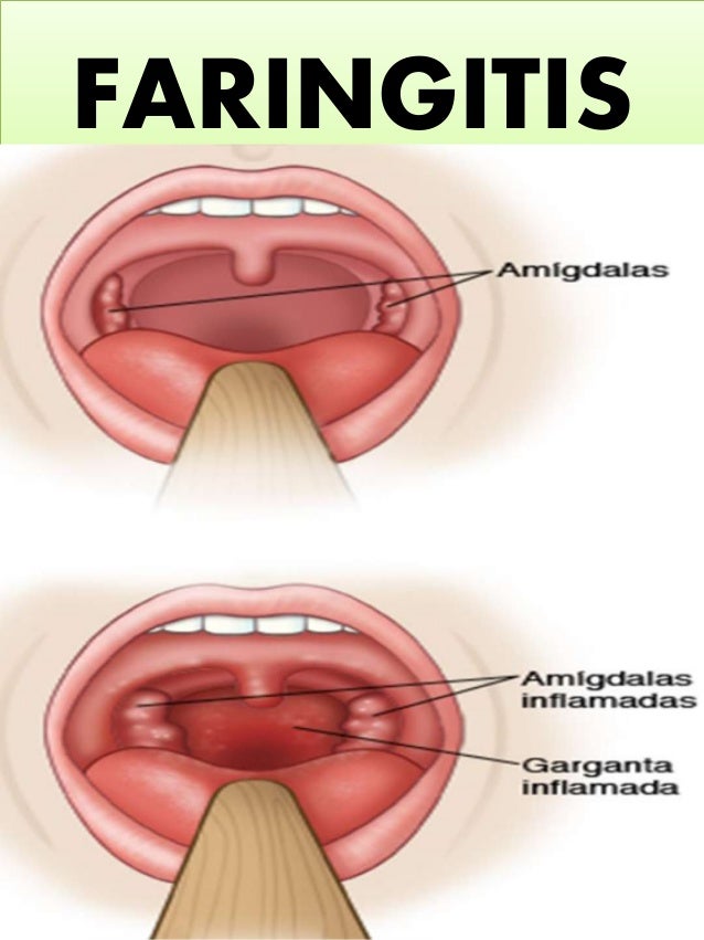 Detail Gambar Penyakit Faringitis Nomer 24