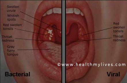 Detail Gambar Penyakit Faringitis Nomer 40