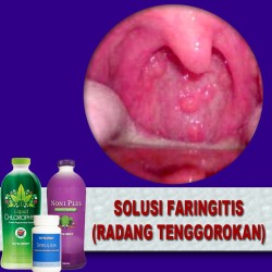 Detail Gambar Penyakit Faringitis Nomer 41