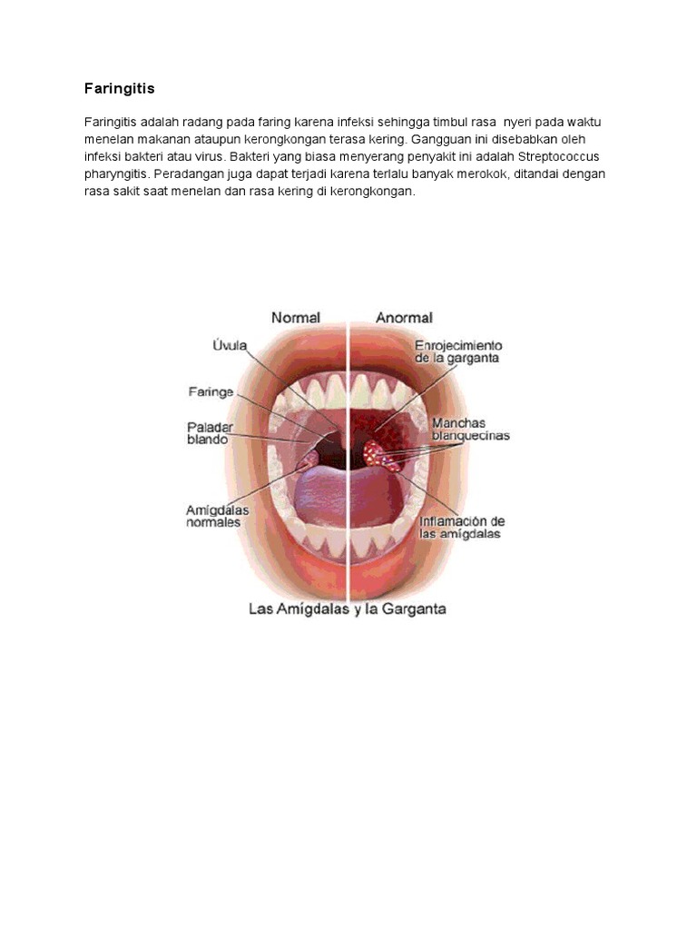 Detail Gambar Penyakit Faringitis Nomer 5