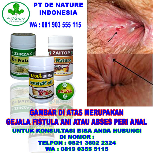 Detail Gambar Penyakit Fistula Ani Nomer 9