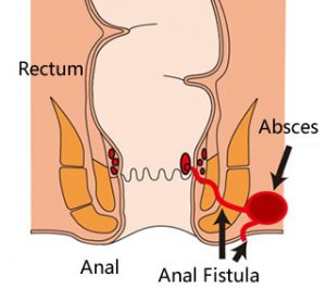 Detail Gambar Penyakit Fistula Ani Nomer 11