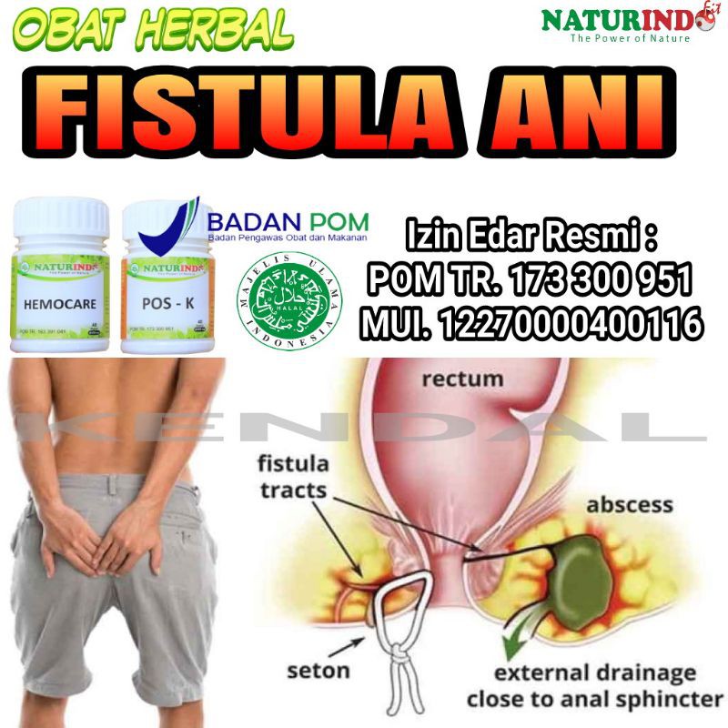 Detail Gambar Penyakit Fistula Ani Nomer 15