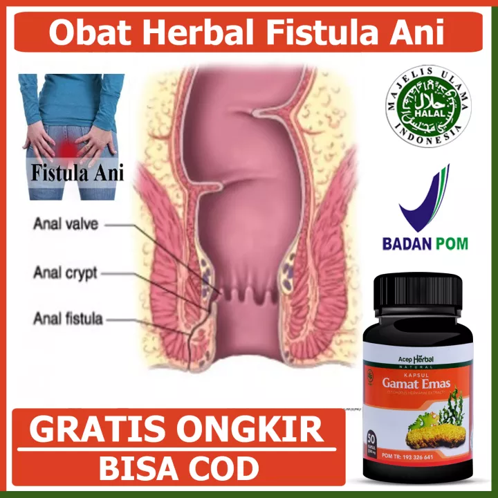 Detail Gambar Penyakit Fistula Ani Nomer 16