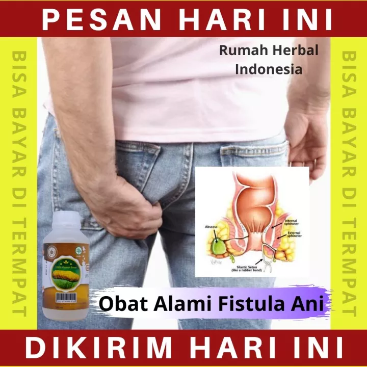 Detail Gambar Penyakit Fistula Ani Nomer 35