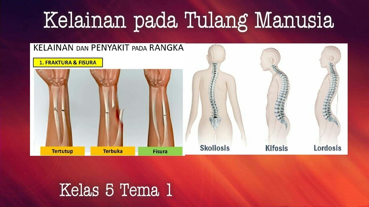 Detail Gambar Penyakit Fraktura Nomer 21