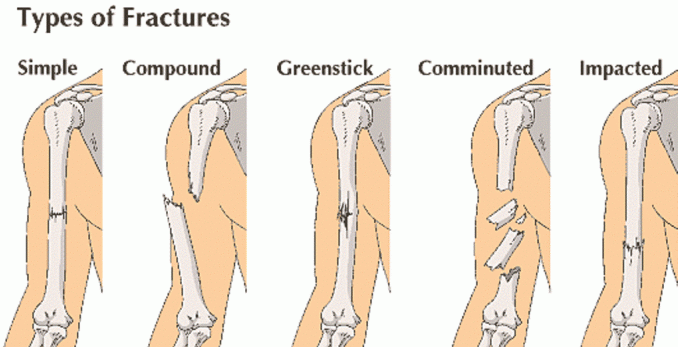 Detail Gambar Penyakit Fraktura Nomer 24