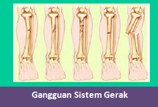 Detail Gambar Penyakit Fraktura Nomer 47