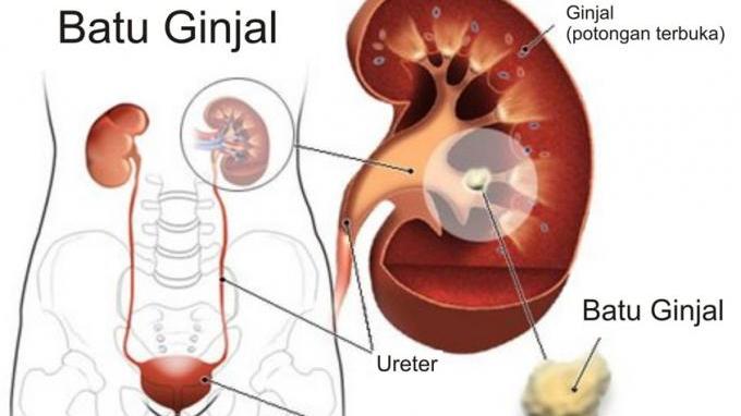 Detail Gambar Penyakit Ginjal Nomer 33