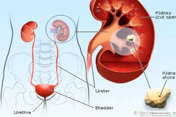 Detail Gambar Penyakit Ginjal Nomer 37