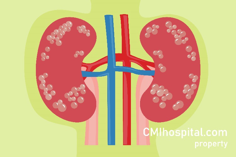 Detail Gambar Penyakit Ginjal Akut Nomer 12
