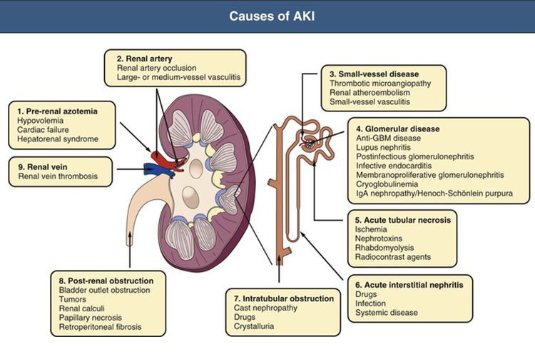 Detail Gambar Penyakit Ginjal Akut Nomer 17